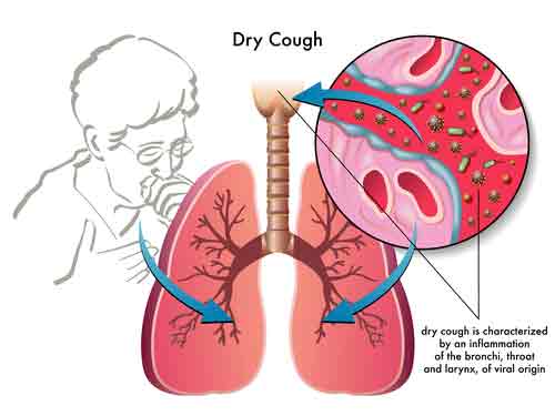 Dust Allergy Symptoms