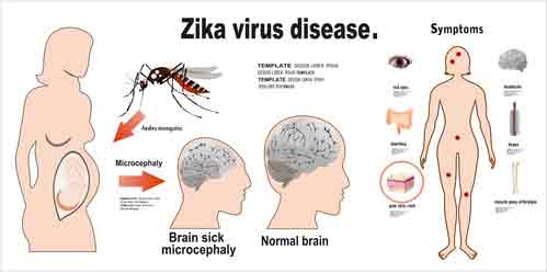 Zika Virus Symptoms